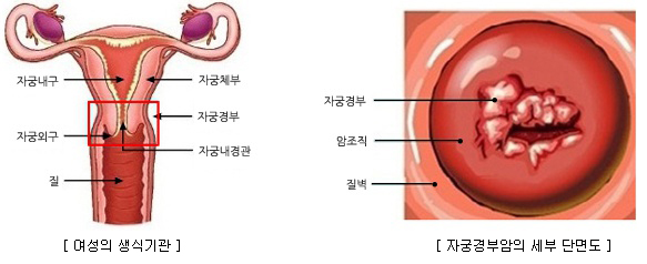 여성 생식기관과 자궁경부암의 세부단면도