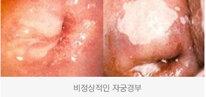 비정상적인 자궁경부