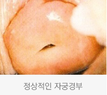 정상적인 자궁경부