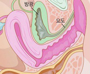 요실금수술 전