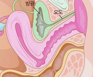 요실금수술 후